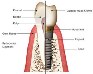 Diagram of a dental implant