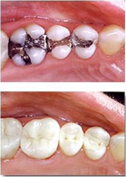 Photo comparing amalgam to white fillings