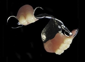 Photo of removable partial dentures